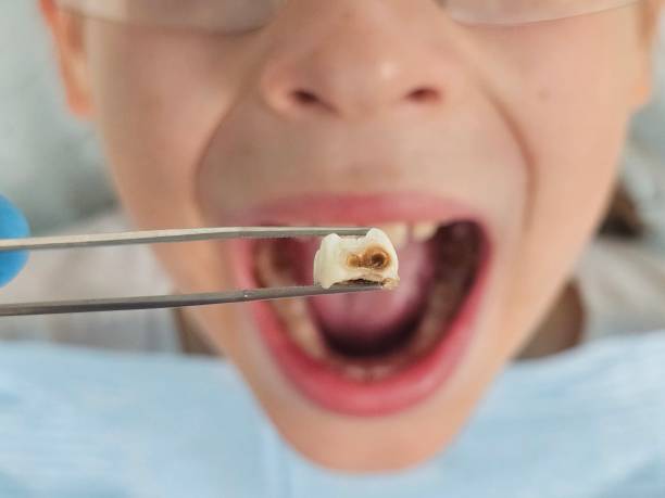 Best Emergency Tooth Extraction in South Pekin, IL